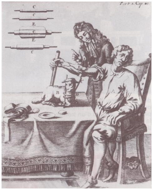 First transfusion in humans by French physician Jean-Baptiste Denis